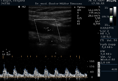 Carotis Duplex / Doppler